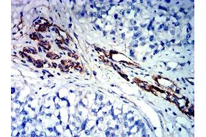 Immunohistochemical analysis of paraffin-embedded bladder cancer tissues using FLI1 mouse mAb with DAB staining.