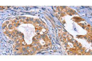 Immunohistochemistry of paraffin-embedded Human cervical cancer using MUSK Polyclonal Antibody at dilution of 1:30 (MUSK anticorps)