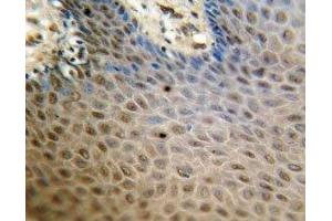 SREBP2 antibody immunohistochemistry analysis in formalin fixed and paraffin embedded human skin carcinoma.