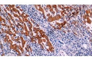 Detection of Bcl2 in Human Liver cancer Tissue using Polyclonal Antibody to B-Cell Leukemia/Lymphoma 2 (Bcl2)