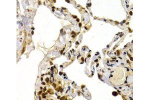 Immunohistochemistry of paraffin-embedded Human lung using TFDP1 Polyclonal Antibody at dilution of 1:200 (40x lens). (DP1 anticorps)
