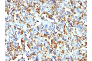 Formalin-fixed, paraffin-embedded human Histiocytoma stained with Factor XIIIa Mouse Monoclonal Antibody (F13A1/1683). (F13A1 anticorps  (AA 46-181))