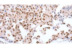 Immunohistochemistry of paraffin-embedded Human lung cancer tissue using Oct-6 Polyclonal Antibody at dilution 1:40 (POU3F1 anticorps)