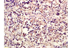 Formalin-fixed and paraffin embedded human lung carcinoma labeled with Anti-NCR3 Polyclonal Antibody, Unconjugated (ABIN739980) at 1:200 followed by conjugation to the secondary antibody and DAB staining