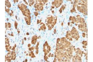 Formalin-fixed, paraffin-embedded human Melanoma stained with S100B-Monospecific Recombinant Rabbit Monoclonal Antibody (S100B/1706R). (Recombinant S100B anticorps)