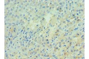 Immunohistochemistry of paraffin-embedded human liver cancer using ABIN7143277 at dilution of 1:100 (APRT anticorps  (AA 1-180))