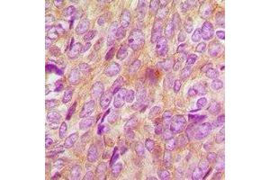 Immunohistochemical analysis of BMPR1B staining in human breast cancer formalin fixed paraffin embedded tissue section.