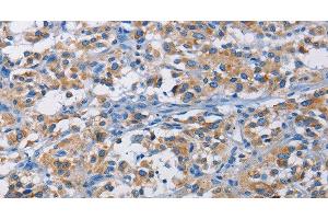 Immunohistochemistry of paraffin-embedded Human thyroid cancer tissue using RICTOR Polyclonal Antibody at dilution 1:50
