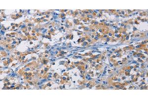 Immunohistochemistry of paraffin-embedded Human thyroid cancer tissue using RICTOR Polyclonal Antibody at dilution 1:50 (RICTOR anticorps)