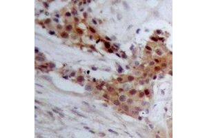 Immunohistochemical analysis of BAP1 staining in human breast cancer formalin fixed paraffin embedded tissue section. (BAP1 anticorps)