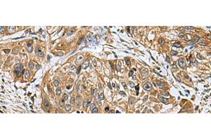 Immunohistochemistry of paraffin-embedded Human esophagus cancer tissue using EARS2 Polyclonal Antibody at dilution of 1:30(x200) (EARS2 anticorps)