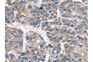 The image on the left is immunohistochemistry of paraffin-embedded Human liver cancer tissue using ABIN7190040(CACNA1G Antibody) at dilution 1/20, on the right is treated with synthetic peptide. (CACNA1G anticorps)