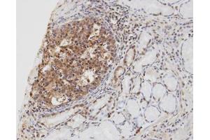 IHC-P Image Immunohistochemical analysis of paraffin-embedded human gastric cancer, using cylindromatosis 1, antibody at 1:100 dilution. (CYLD anticorps  (C-Term))