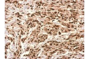 IHC-P Image UTP6 antibody detects UTP6 protein at nucleus on U251 xenograft by immunohistochemical analysis. (UTP6 anticorps  (Center))