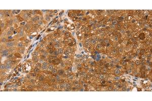 Immunohistochemistry of paraffin-embedded Human breast cancer tissue using TMSB10 Polyclonal Antibody at dilution 1:35 (Thymosin beta 10 anticorps)