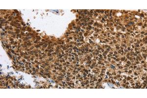 Immunohistochemistry of paraffin-embedded Human lung cancer using ELAVL1 Polyclonal Antibody at dilution of 1:40 (ELAVL1 anticorps)