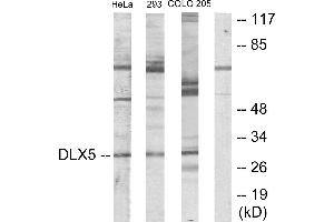 Immunohistochemistry analysis of paraffin-embedded human lung carcinoma tissue using DLX5 antibody. (DLX5 anticorps)