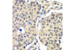 Immunohistochemistry of paraffin-embedded human lung cancer using CCNC antibody at dilution of 1:100 (x40 lens). (Cyclin C anticorps)