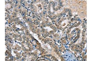 The image on the left is immunohistochemistry of paraffin-embedded Human thyroid cancer tissue using ABIN7192312(SEPN1 Antibody) at dilution 1/20, on the right is treated with synthetic peptide. (Selenoprotein N anticorps)