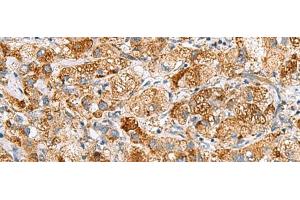 Immunohistochemistry of paraffin-embedded Human liver cancer tissue using NMU Polyclonal Antibody at dilution of 1:80(x200) (Neuromedin U anticorps)