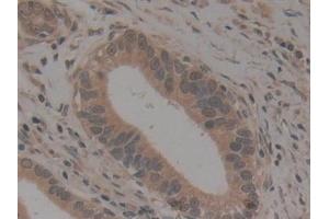 Detection of gp210 in Human Stomach cancer Tissue using Polyclonal Antibody to Nuclear Pore Glycoprotein 210 (gp210)