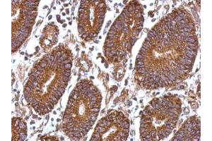 IHC-P Image Immunohistochemical analysis of paraffin-embedded human colon carcinoma, using Laminin beta 1, antibody at 1:500 dilution.