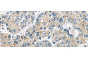 Immunohistochemistry of paraffin-embedded Human liver cancer tissue using MASP2 Polyclonal Antibody at dilution 1:35 (MASP2 anticorps)