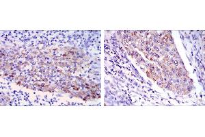 Immunohistochemical analysis of paraffin-embedded human cervical cancer tissues (left) and human kidney cancer tissues (right) using MMP1 mouse mAb with DAB staining.