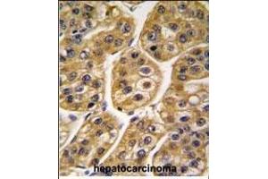 Formalin-fixed and paraffin-embedded human hepatocarcinoma tissue reacted with IDH1 antibody (Center), which was peroxidase-conjugated to the secondary antibody, followed by DAB staining. (IDH1 anticorps  (AA 116-143))