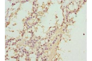 Immunohistochemistry of paraffin-embedded human breast cancer using ABIN7144903 at dilution of 1:100 (ABCC11 anticorps  (AA 1-170))