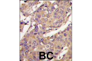 Formalin-fixed and paraffin-embedded breast carcinoma tissue reacted with UBE2L6 Antibody , which was peroxidase-conjugated to the secondary antibody, followed by DAB staining.