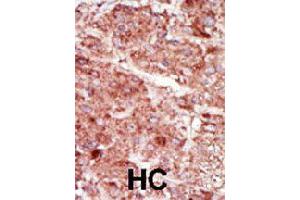 Formalin-fixed and paraffin-embedded human hepatocellular carcinoma tissue reacted with HK3 polyclonal antibody  , which was peroxidase-conjugated to the secondary antibody, followed by AEC staining. (HK3 anticorps  (C-Term))