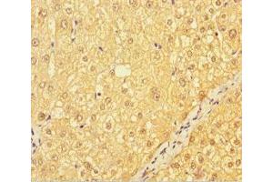 Immunohistochemistry of paraffin-embedded human liver cancer using ABIN7147035 at dilution of 1:100 (CATSPER4 anticorps  (AA 306-472))