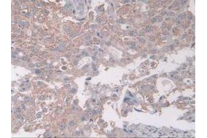 IHC-P analysis of Human Breast Cancer Tissue, with DAB staining. (Coxsackie Adenovirus Receptor anticorps  (AA 20-229))