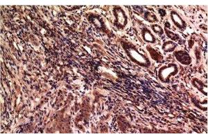 Immunohistochemistry of paraffin-embedded Human breast carcinoma tissue using gamma Tubulin Monoclonal Antibody at dilution of 1:200.