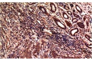 Immunohistochemistry of paraffin-embedded Human breast carcinoma tissue using gamma Tubulin Monoclonal Antibody at dilution of 1:200. (TUBG1 anticorps)