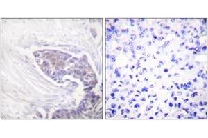Immunohistochemistry analysis of paraffin-embedded human breast carcinoma tissue, using TRXR2 Antibody.