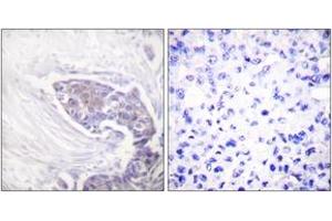Immunohistochemistry analysis of paraffin-embedded human breast carcinoma tissue, using TRXR2 Antibody. (TXNRD2 anticorps  (AA 471-520))