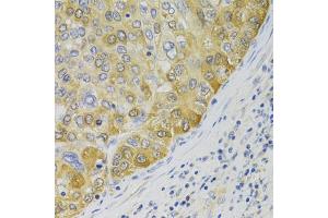 Immunohistochemistry of paraffin-embedded human liver cancer using PA2G4 Antibody (ABIN5973112) at dilution of 1/100 (40x lens). (PA2G4 anticorps)