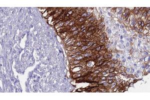 ABIN6268717 at 1/100 staining Human urothelial cancer tissue by IHC-P. (Aquaporin 5 anticorps  (C-Term))