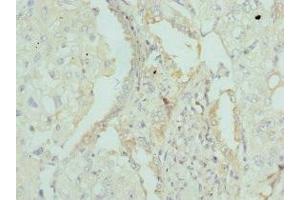 Immunohistochemistry of paraffin-embedded human lung cancer using ABIN7144441 at dilution of 1:100 (Apolipoprotein M anticorps  (AA 23-188))