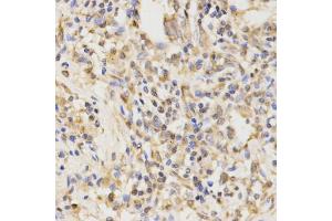 Immunohistochemistry of paraffin-embedded human lung cancer using ATG5 antibody (ABIN4902970) at dilution of 1:100 (40x lens). (ATG5 anticorps)