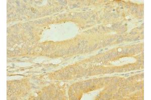 Immunohistochemistry of paraffin-embedded human endometrial cancer using ABIN7156048 at dilution of 1:100
