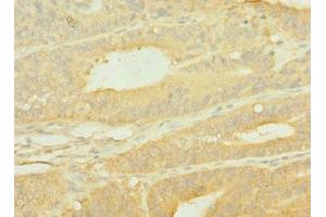 Immunohistochemistry of paraffin-embedded human endometrial cancer using ABIN7156048 at dilution of 1:100 (SLC1A2 anticorps  (AA 306-348))