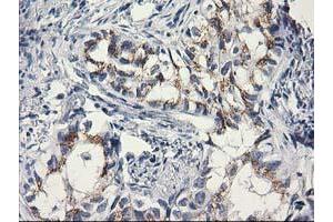 Immunohistochemical staining of paraffin-embedded Carcinoma of Human lung tissue using anti-C1orf50 mouse monoclonal antibody. (C1ORF50 anticorps)