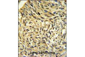 FKBP14 Antibody IHC analysis in formalin fixed and paraffin embedded human Lung carcinoma followed by peroxidase conjugation of the secondary antibody and DAB staining.