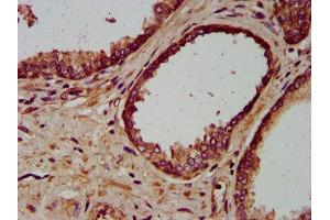 IHC image of ABIN7157984 diluted at 1:200 and staining in paraffin-embedded human prostate cancer performed on a Leica BondTM system. (Mip (AA 220-263) anticorps)