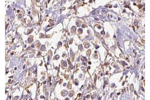 ABIN6277027 at 1/100 staining Human breast cancer tissue by IHC-P. (EXT1 anticorps)