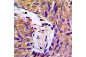 Immunohistochemical analysis of IKK alpha/beta (pS180/181) staining in human breast cancer formalin fixed paraffin embedded tissue section. (IKK-alpha /IKK-beta anticorps  (pSer180, pSer181))