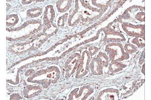 IHC-P Image Immunohistochemical analysis of paraffin-embedded human ovarian cancer, using HOMER1, antibody at 1:100 dilution.